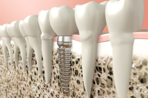 When Bone Grafting Is Needed From An Implant Dentist For Tooth Replacement