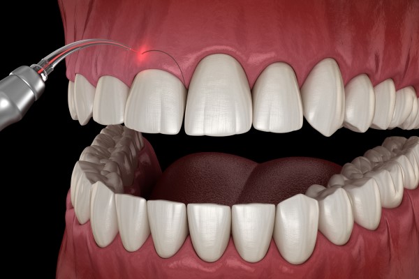 Receding Gums: Will I Need To Get A Gum Graft?